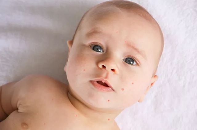 手足口病高发!Blueair净化器让家庭杜绝空气中的EV71病毒 EV71病毒,清EV71病毒,清除EV71病毒,预防手口足,净化器杀菌